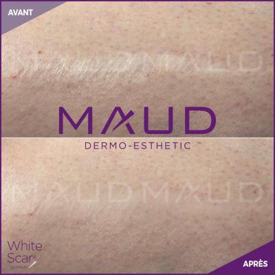 Life repair cicatrice white scar maud dermo esthetic 2 800x800 1